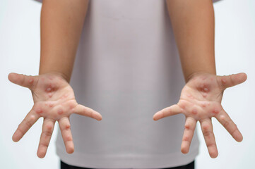 Hand, foot and mouth disease HFMD Human hand of scarlet fever in coxsackievirus palmarosa virus and...