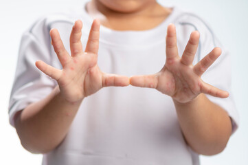 Hand, foot and mouth disease HFMD Human hand of scarlet fever in coxsackievirus palmarosa virus and child hand on white background
