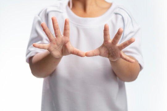 Hand, foot and mouth disease HFMD Human hand of scarlet fever in coxsackievirus palmarosa virus and child hand on white background
