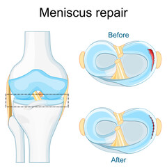 Meniscus injury and healing. Close-up of knee joint.