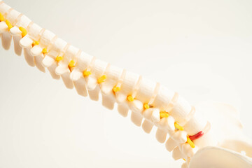 Spinal nerve and bone, Lumbar spine displaced herniated disc fragment, Model for treatment medical...