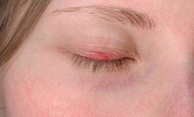 Inflammation on the eyelid, stye on the eye