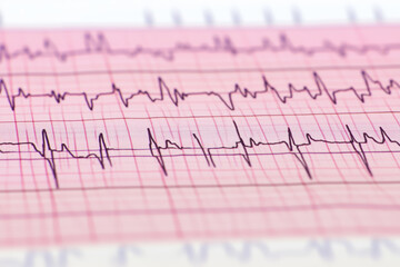 ECG electrocardiogram