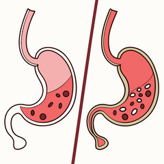 Fototapeta premium Human stomach. Healthy and unhealthy, Bloating stomach ache, digestive tract pain fullness heaviness stomaches acid heartburn process