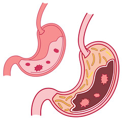 Human stomach. Healthy and unhealthy, Bloating stomach ache, digestive tract pain fullness heaviness stomaches acid heartburn process