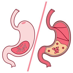 Human stomach. Healthy and unhealthy, Bloating stomach ache, digestive tract pain fullness heaviness stomaches acid heartburn process