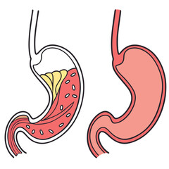 Human stomach. Healthy and unhealthy, Bloating stomach ache, digestive tract pain fullness heaviness stomaches acid heartburn process