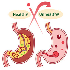 Human stomach. Healthy and unhealthy, Bloating stomach ache, digestive tract pain fullness heaviness stomaches acid heartburn process