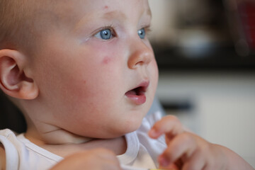 Closeup portrait of the baby with infection on the face caused by insect, mosquito or bee bites.