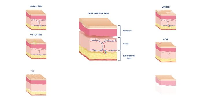 Various skin types. Moving banner with diagram of different types of skin with dermis and epidermis. Anatomical structure. Acne, cellulite, vitiligo and wrinkles. Isometric 3D graphic animated cartoon