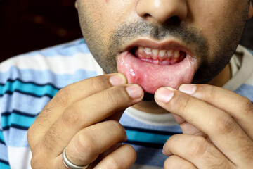 Asian man have aphthous ulcers on mout\