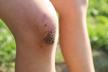 Close-up of a child's knee with a noticeable abrasion on the skin, indicating active games and...
