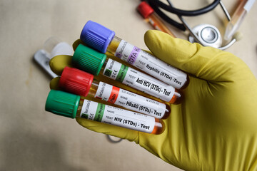 Syphilis, Anti HCV, HBsAG, and HIV - STDs - Test with blood sample in yellow gloved hands....