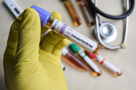 Cerebrospinal Fluid - CSF Test with blood sample in yellow gloved hands. healthcare or Medical concept