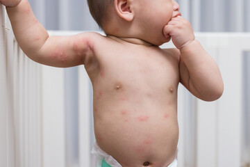 Toddler with red rash showing on skin