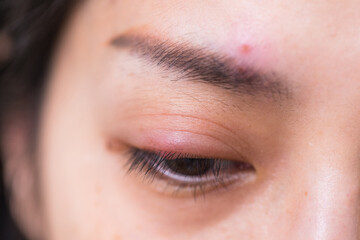 Obraz premium Woman with painful eye stye