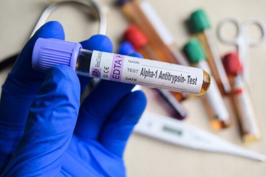 Alpha-1 Antitrypsin - Test with blood sample in blue gloved hands. healthcare or Medical concept