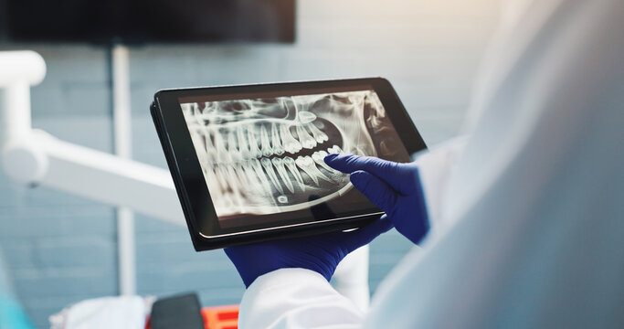 Hands, dentist and tablet screen for x ray, tooth diagnosis or planning for healthcare treatment. Person, check and dental surgeon with digital tech for teeth structure, orthodontic procedure or help