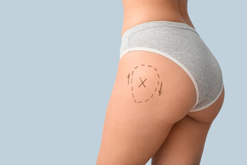 Young woman in underwear with marks on her butt against light background, closeup. Plastic surgery...