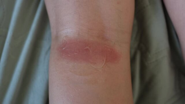 Swollen insect bite on the leg causes redness and inflamed skin with clear irritation and puffiness around the wound under soft natural light