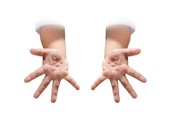 Hand, foot and mouth disease HFMD Human hand of scarlet fever in coxsackievirus palmarosa virus and child hand on white background