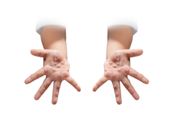 Hand, foot and mouth disease HFMD Human hand of scarlet fever in coxsackievirus palmarosa virus and child hand on white background