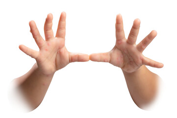 Hand, foot and mouth disease HFMD Human hand of scarlet fever in coxsackievirus palmarosa virus and child hand on white background