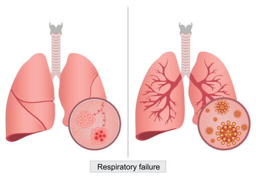 Respiratory failure happens when not enough oxygen passes from lungs to blood.