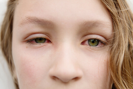 Close up of girl with eye infection