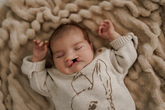 A sleeping newborn baby with congenital defect of cleft lip and palate wrapped in a cozy blanket, resting peacefully in a crib. The baby has a serene expression