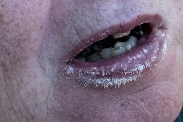 Dehydrated lips showing severe dryness and lack of moisture