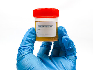 Gloved hand holding a sterile urine sample container with a red lid.