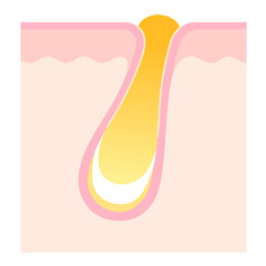 角栓の詰まった毛穴　断面図