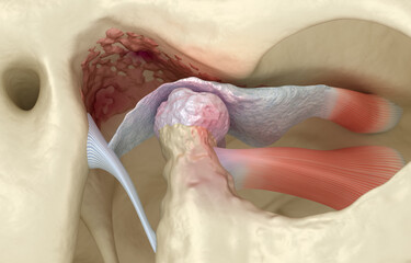 Temporomandibular joints arthritis and dislocated articular disc. Dental 3D illustration