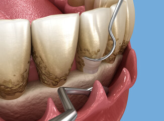 Open curettage: Scaling and root planing (conventional periodontal therapy). 3D illustration
