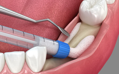 Fototapeta na wymiar Bone grafting augmentation for tooth implantation. Medically accurate 3D illustration