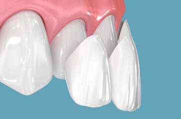Dental veneers on blue background. 3D illustration