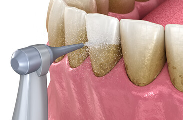 Oral hygiene: Air flow teeth cleaning process. Dental 3D illustration
