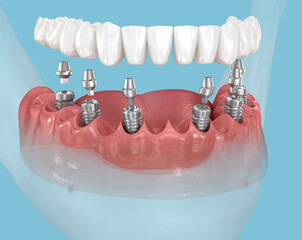 Mandibular prosthesis with gum supported by 6 implants. 3D illustration of human teeth and dentures concept