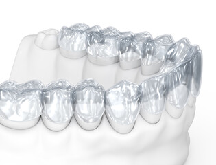 Invisalign braces or invisible retainer on white. Medically accurate dental 3D illustration