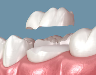 Onlay ceramic crown placement. Medically accurate 3D illustration