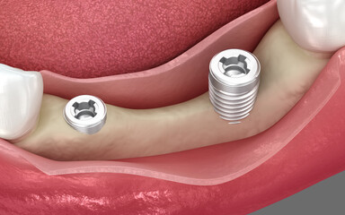 Dental implants and bone lost. 3D illustration
