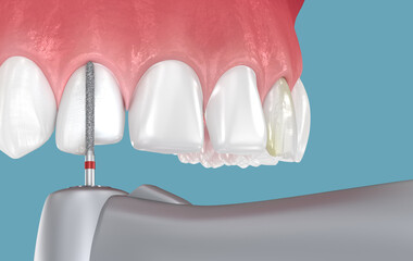 Dental veneer placement, preparation process. 3D illustration