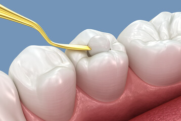 Naklejka na ściany i meble Toth restoration with filling. Tooth 3D illustration.