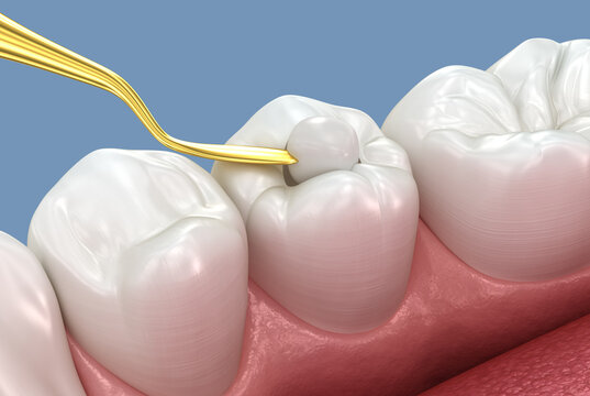 Toth restoration with filling. Tooth 3D illustration.