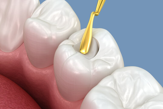 Toth restoration with filling. Tooth 3D illustration.