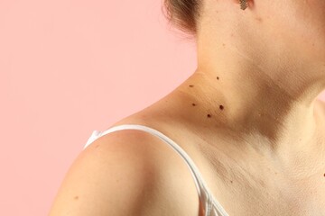 Woman with moles on her skin against pink background, closeup
