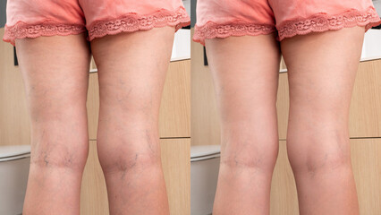 Side-by-side comparison of female legs before and after varicose veins therapy. Visible improvement...