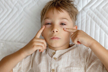 Toddler child with conjuctivitis, lying in bed with red eyes, inflamation of eye disease, cured with eye drops
