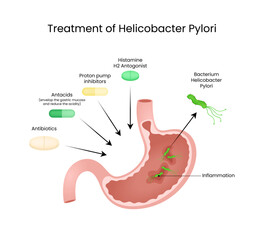 Treatment of Helicobacter Pylori Visual Guide